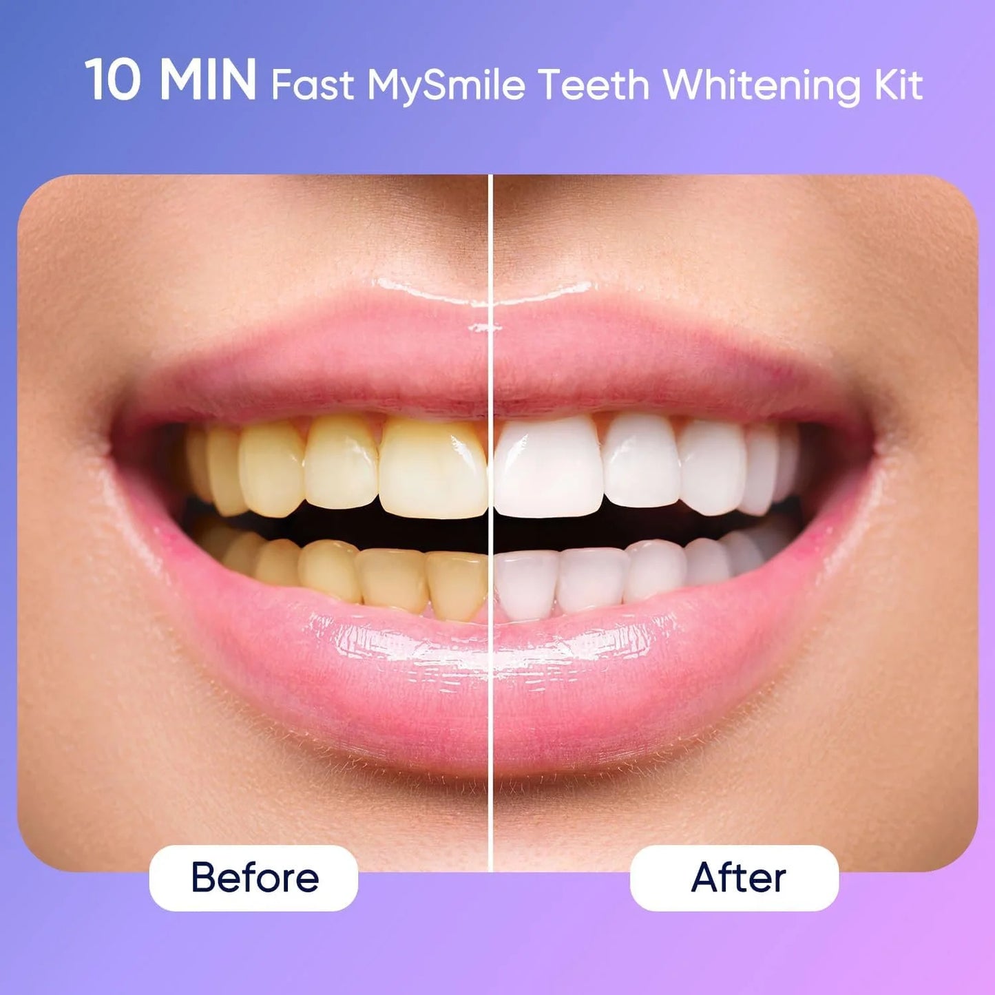LED Teeth Whitening Kit — Visibly Brighter in 10 Minutes