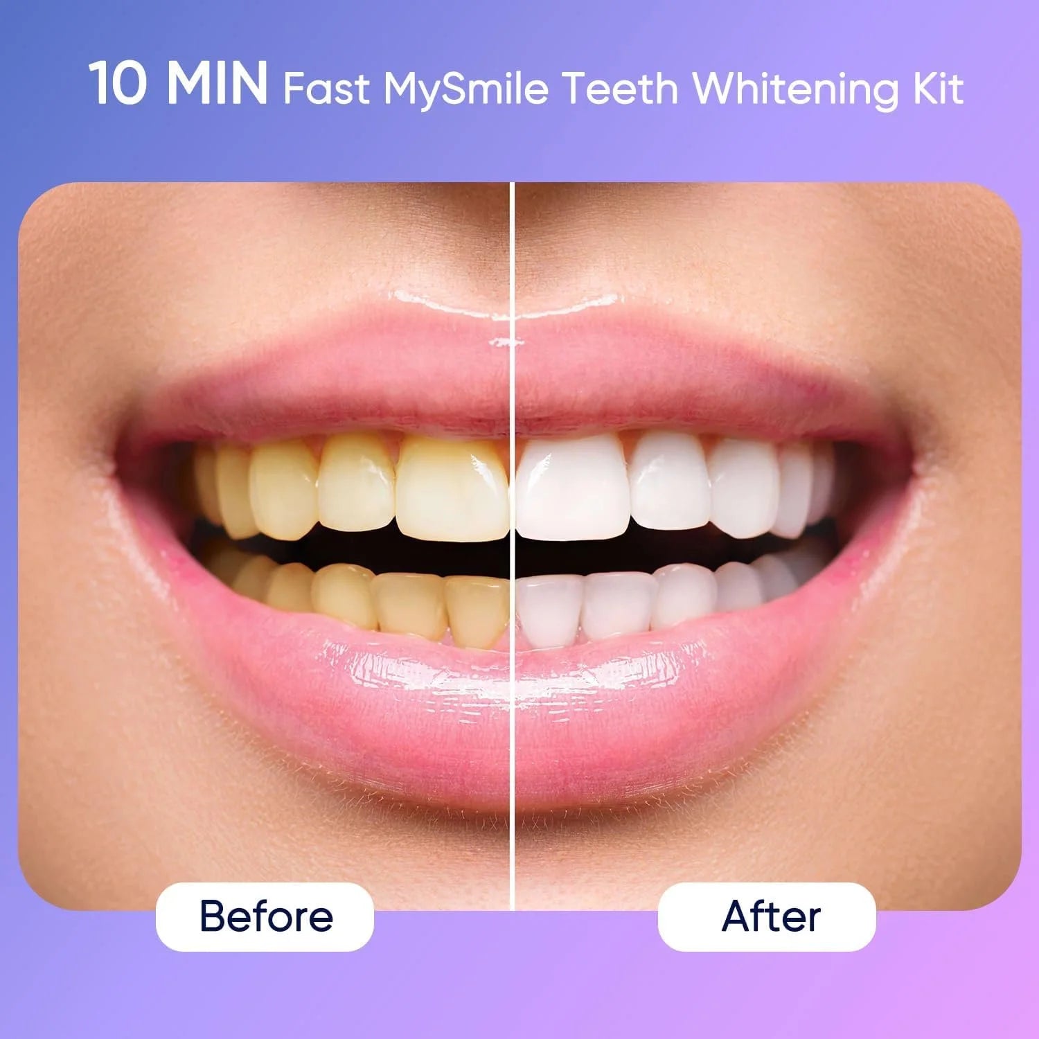 LED Teeth Whitening Kit — Visibly Brighter in 10 Minutes